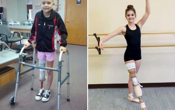 15-летняя балерина без ноги, балет девочка с протезом, танцует с протезом
