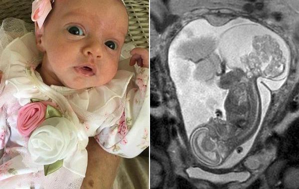 девочка родилась два раза, удалили эмбрион из матки для операции, операция на эмбрионе, опухоль у эмбриона