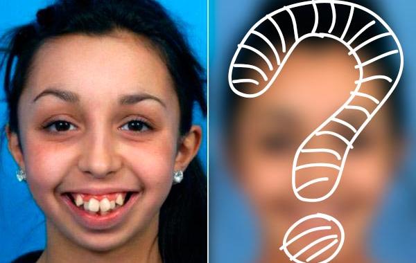 преображение девушки пластической операции челюсти, пластическая коррекция челюсти до и после, изменение челюсти до и после