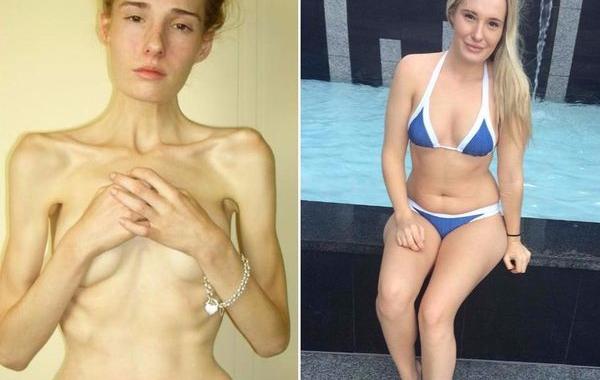 до и после анорексии, люди которые смогли победить анорексию