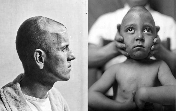 Харви Кушингу, Harvey Cushing, первые пациенты хирургии мозга, первые операции головного мозга, фотографии людей хирургия головного мозга