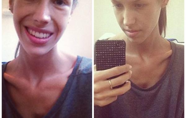 Антония Эрикссон победила анорексию с помощью Instagram