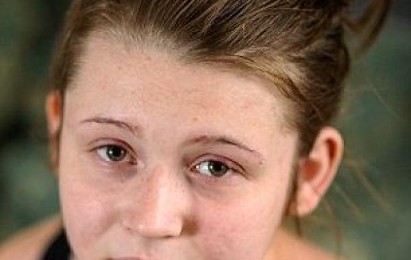 Девушка едва не ослепла после острой аллергической реакции на краску для ресниц