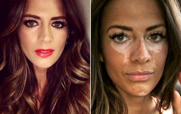 Бреанну Райс, Breanne Rice, прятала витилиго под макияжем, модель показала настоящее лицо, модель витилиго макияж