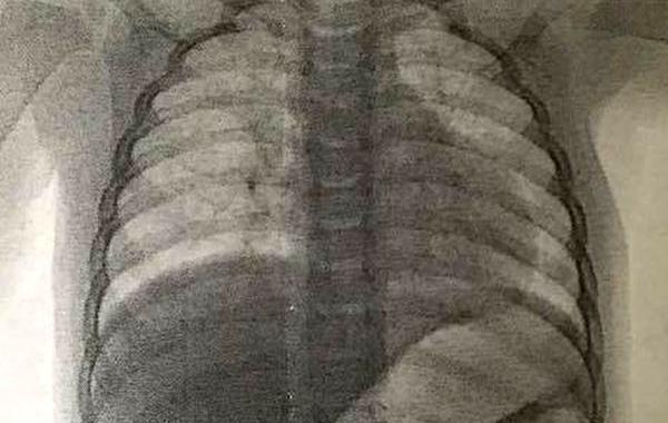 нашла обручальное кольцо в ребёнке, потеряла обручальное кольцо, рентген кольцо в ребёнке