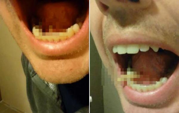 Видео извлечения камня слюнной железы, выдавливание камня слюнной железы, извлечение слюнного камня