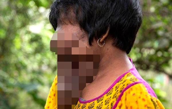 Хадиджа Хатун, Khadija Khatoon, девушка с наростами на лице, наросты на лице нейрофиброматоз