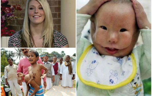 9 историй о людях, родившихся с лишними частями тела