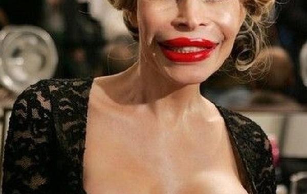 жертвы пластической хирургии знаменитости пластика