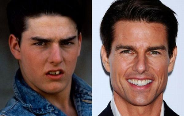 Звезды, знаменитости, до и после, дантиста, зубы