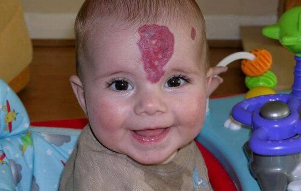 Ребенку сделали операцию по  удалению пятна