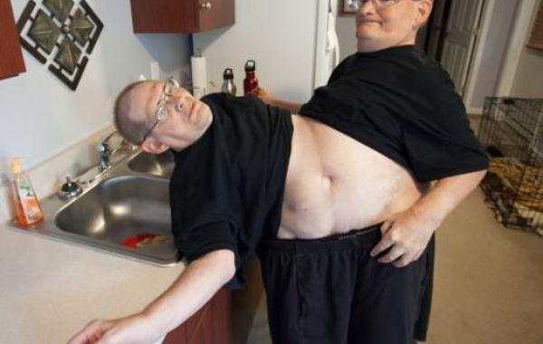 Ronnie Donnie Galyon, Ронни и Донни Гэлион, самые старые сиамские близнецы, 