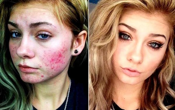 девушки маскируют проблемную кожу, макияж до и после