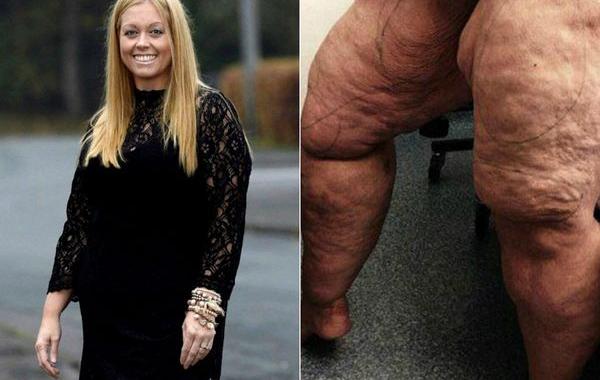 лечение липедемы, жир на ногах женщины липедема, пластическая операция липедема, липосакция липедема, откачка жира с ног липедема