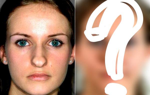 ринопластика до и после, пластика носа до и после, сравнительные фотографии ринопластика, сравнительные фотографии пластика носа