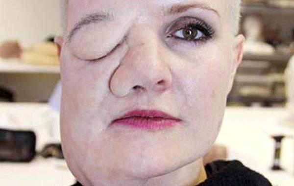 Ли де Врис, Leigh de Vries, Воображаемое уродство, себя на самом деле чувствуют дисморфобия, фейковая опухоль на лице девушки