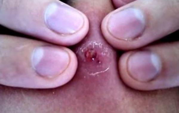 самый большой прыщ в мире, выдавливание самого большого прыща видео, Энди Пепперс, Andy Peppers