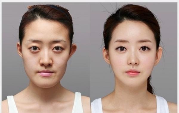 Пластические операции, Южная Корея, фото