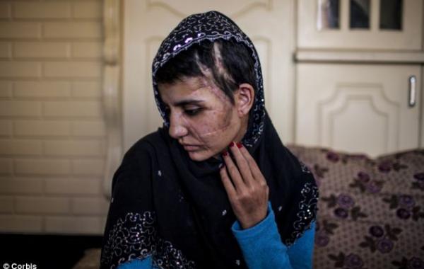 Девуша, шрамы, удары топором, Гюль