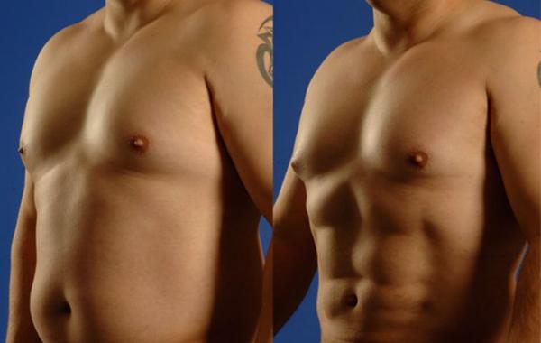 пластическая операция,кубики пресса 