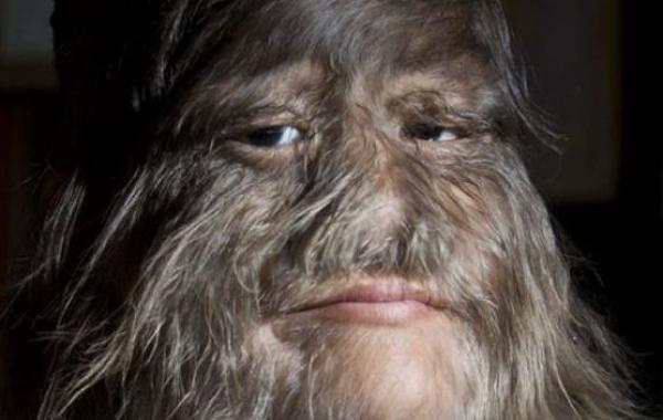 Редкие врожденные заболевания, которые чудовищно уродуют тела людей