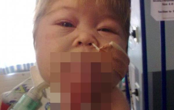 огромный язык, синдром Беквита-Видемана, Оливия Гиллис