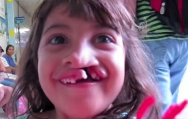 Первая улыбка маленькой девочки, после хирургического исправления волчьей пасти