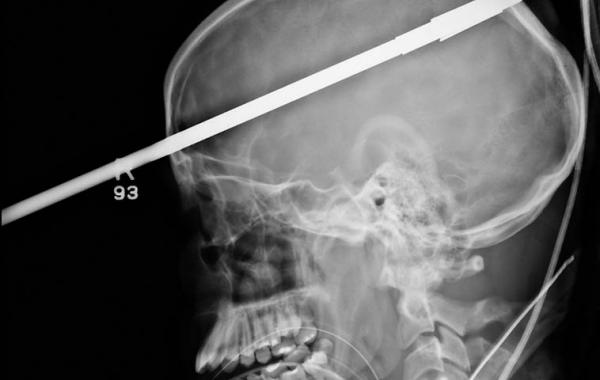 Рентгеновские снимки, рентген ужас, страшные рентгеновские снимки