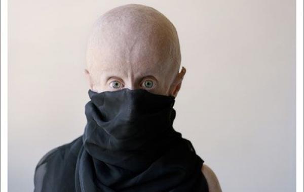 DJ Leon Botha и его страшная болезнь, прогерия