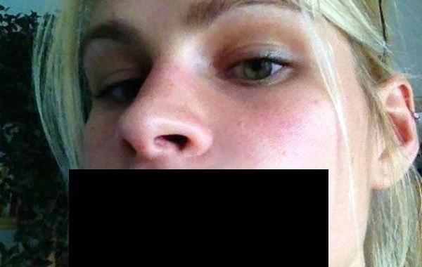 ботокс укус пчелы аллергия на укус 