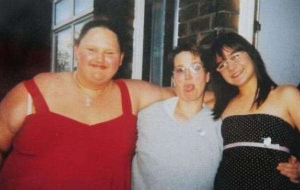 Толстая девушка похудела и заболела анорексией