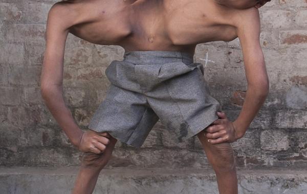 Сиамские близнецы, считающиеся индийским божеством, Близнецы отказываются от операции по разделению