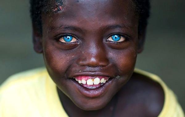 африканский мальчик с голубыми глазами, темнокожий мальчик с голубыми глазами, негр с голубыми глазами, синдром Ваарденбурга