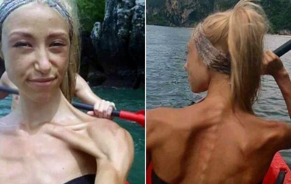 победила анорексию, Софи Гажник, Sophie Gajnik, до и после анорексии, поборола анорексию тяжёлая атлетика