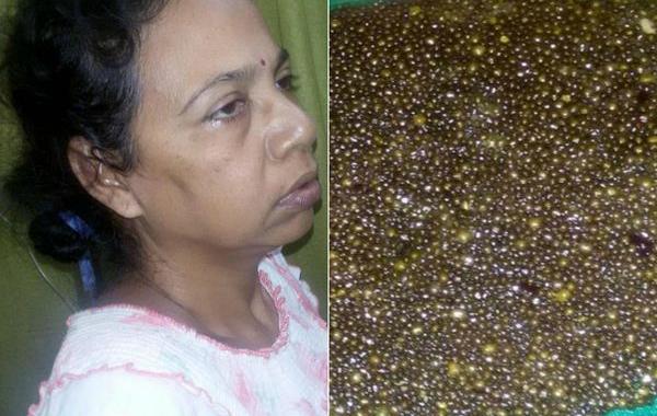 Минати Мондал, Minati Mondal, 12000 желчных камней, 12000 камней в желчном пузыре, удалены 12 тысяч камней из желчного пузыря