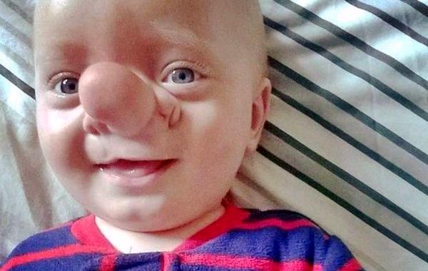 Олли Трезис, Ollie Trezise, реальный Пиноккио, мальчик родился с частью мозга в носу,ребенок с энцефалоцеле