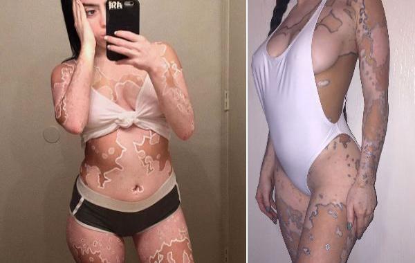 издевались над девушкой с витилиго, модель с витилиго, Эшли Сото, Ashley Soto, инстаграм Эшли Сото