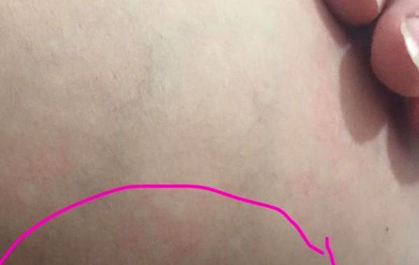 фотография рака груди, поделилась фотографией рака груди