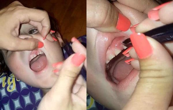 мама нашла ногти во рту сына, ногти застряли в нёбе, ногти в дёснах