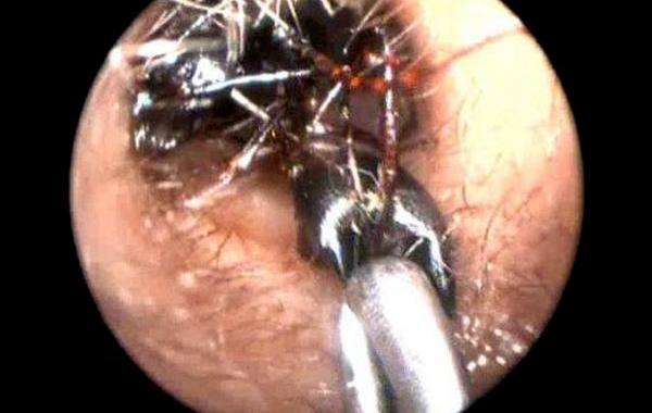 Муравьи из ушей девочки, 1000 муравьев их ушей девочки, муравьи в ушах, Шрея Дарджи, Shreya Darji