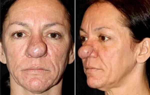 ринофима до и после, тяжёлая форма риноцеи, Памела Ичард, Pamela Ichard, ринофима у женщин