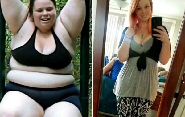 обвисшая кожа после похудения, лишняя кожа после похудения