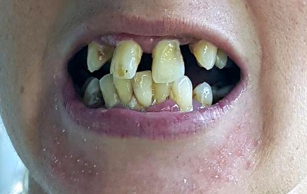 удалили 20 зубов, очень кривые зубы, кривые зубы до и после лечения