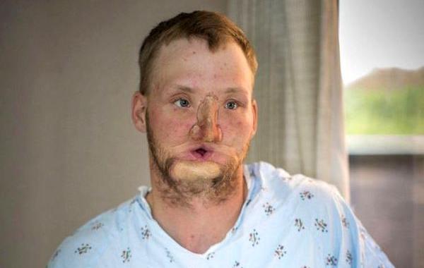 Энди Санднесс, Andy Sandness, Пересадка лица до и после, результат пересадки лица