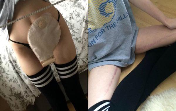 Эйми Роуски, Aimee Rouski,последствия болезни Крона, фото болезнь Крона