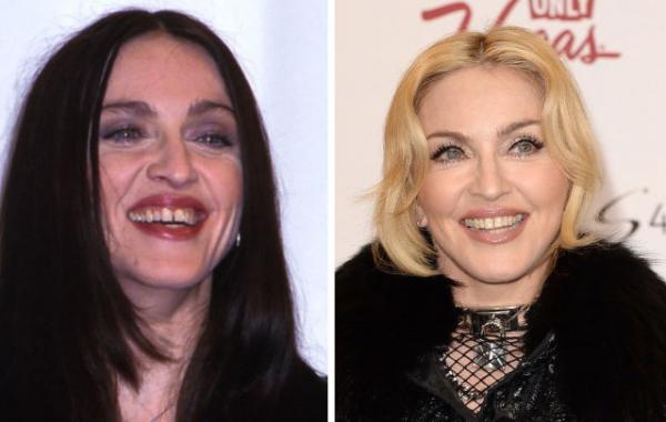 зубы звёзд, зубы знаменитостей до и после