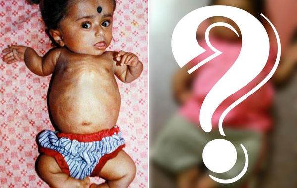 Гириджа Шринивас,Girija Srinivas, девушка в теле 2-летней девочки, девушка в теле двухлетней девочки, 