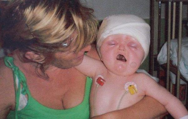 Девочка со редким заболеванием, превратившим её в "сломанную куклу", чье тело было перестроено врачамиДевочка с редким заболеванием, превратившим её в "сломанную куклу", чье тело было перестроено врачами