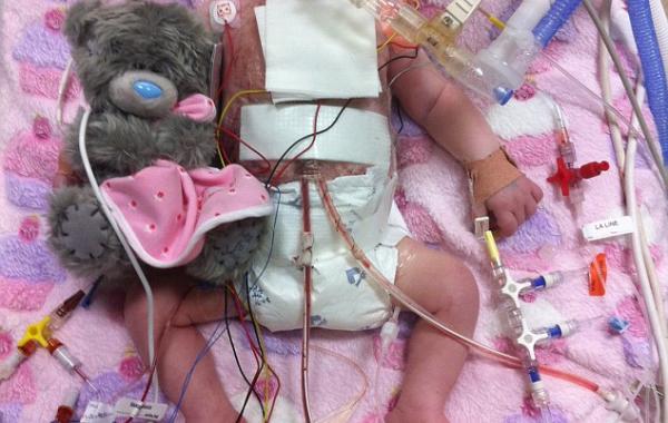 операция на сердце после рождения, Chanel Murrish