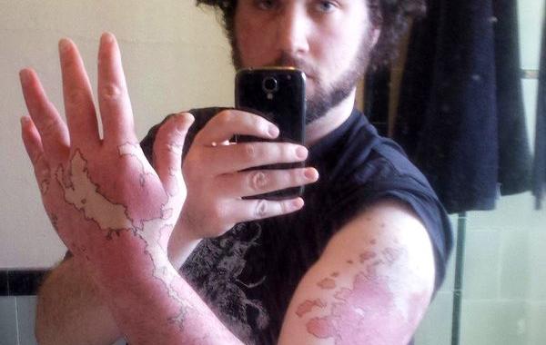 превратил родимое пятно в карту, обвел  родимое пятно чернилам,обвел  родимое пятно ручкой